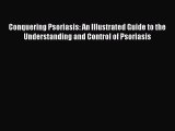 Read Conquering Psoriasis: An Illustrated Guide to the Understanding and Control of Psoriasis