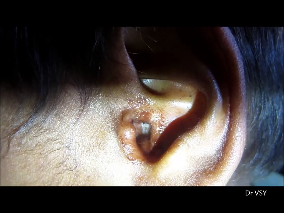 Ce garçon hurle de douleur à cause de ce qui se trouve dans son oreille, ce que le docteur sort? OH MON DIEU!