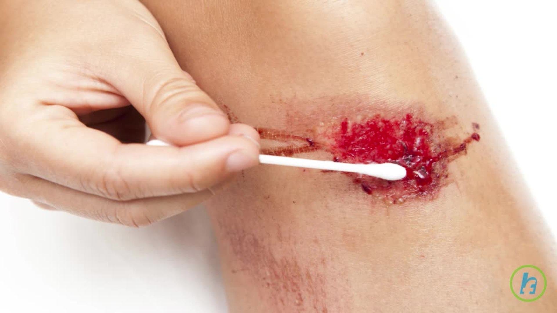 What is Acute Lymphocytic Leukemia?