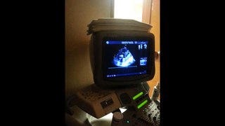 1-25-13 ultrasound baby front view