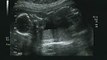 Craig Jr. Baby Boy ultrasound 19 weeks