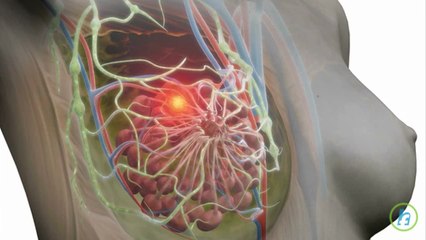 What is Breast Cancer?