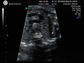 Left superior vena cava with dilated anonymous vein 25 GW