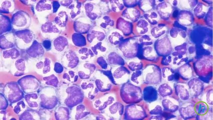 What is Chronic Myelogenous Leukemia?