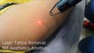 Laser Tattoo Removal at RM Aesthetics