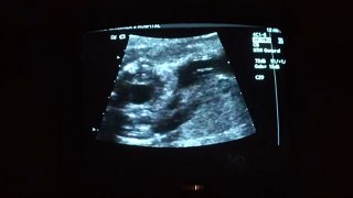 Ultrasound - 02/05/2009 - 25 Weeks