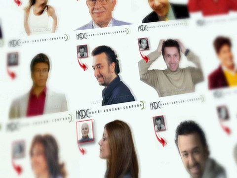 Protez Saç Nasıl Kullanılır? - HDC