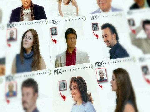 Protez Saç Nedir, Nasıl Yapılır? - HDC