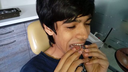 Root Canal Treatments in ahmedabad