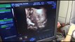 dokter menemukan janin kembar mati di dalam perut anak berusia 4 tahun - Tomonews