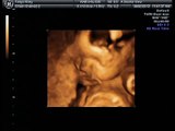 Nathaniel Riley 25 weeks 3d/4d Ultrasound