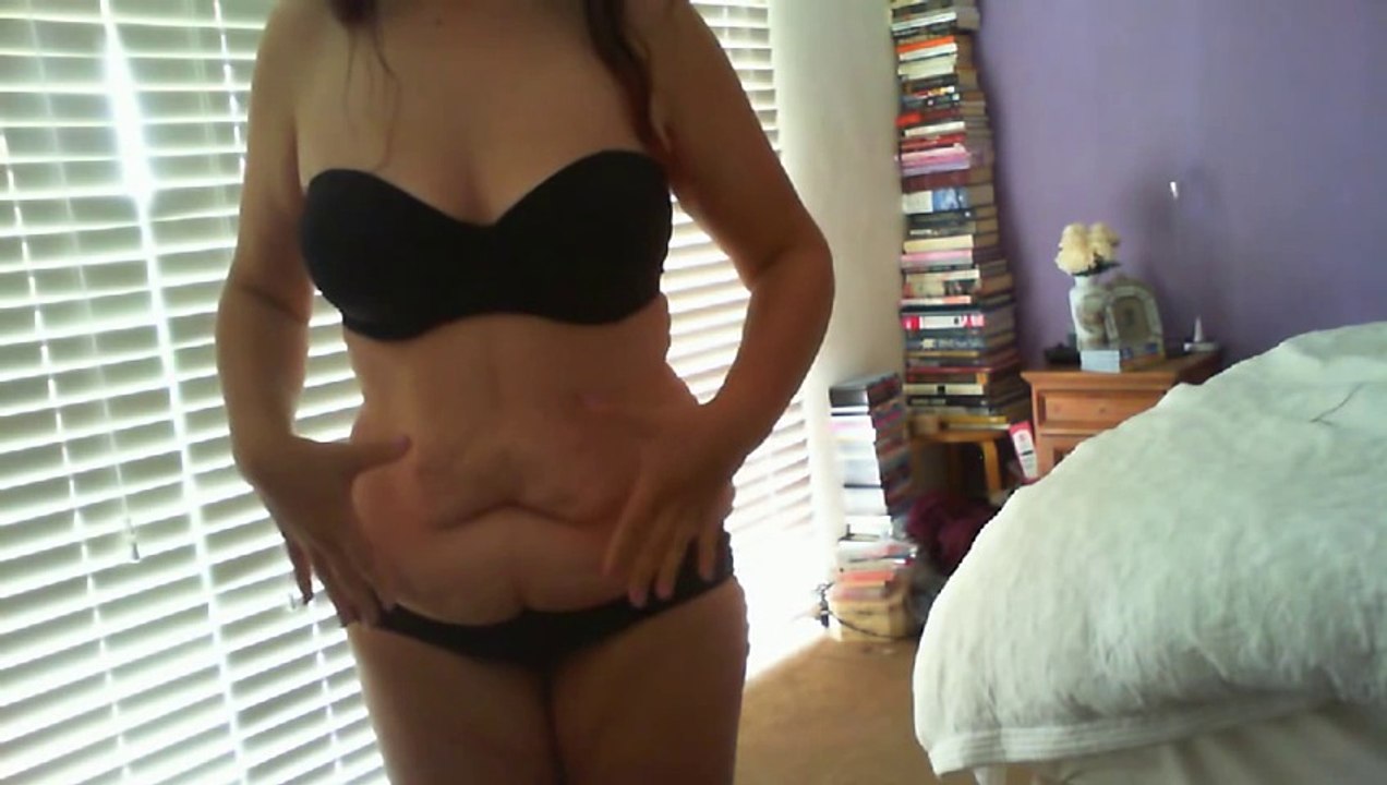 Excess Loose Skin after 70kg Weight Loss