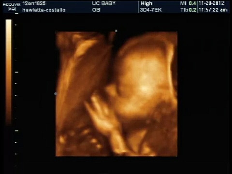 Baby boys heart beat 25 weeks 3d ultrasound nov 20 2012 video Dailymotion
