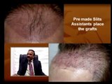 Pre Made Slits For Hair Transplantation - Hair Loss Solutions for both Men & Women