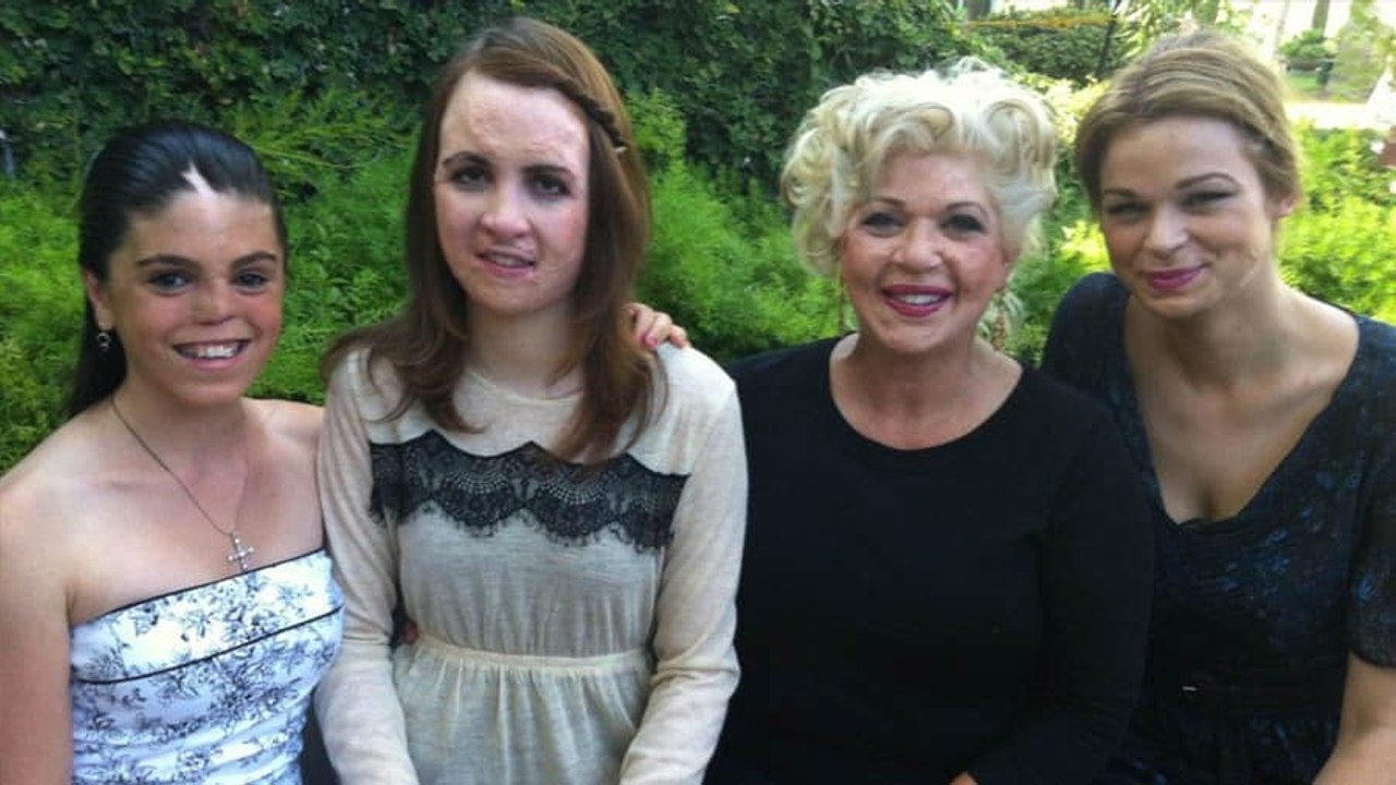This Burn Survivor Created a Special Retreat to Help Others Like Her Heal