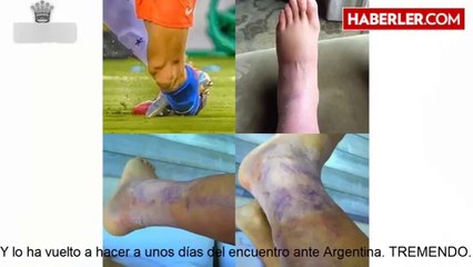 Alexis Sanchez'in Ayağının Son Hali Şoke Etti