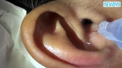 Kulağa kaçan örümcek nasıl çıkarılır