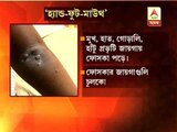 New disease in Kolkata: hand foot mouth disease