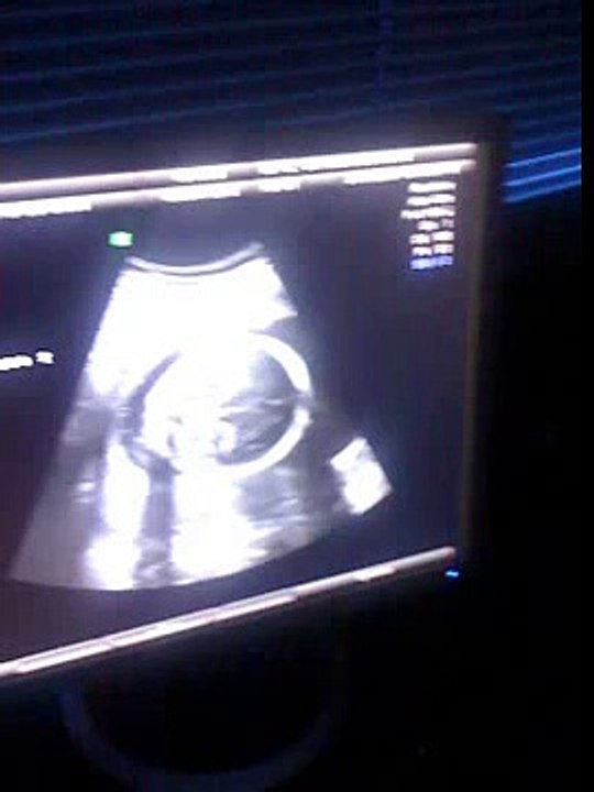 Ecografia 24 semanas - varón