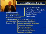 Eye Movements Disorders  ( Cerebellar Eye Signs review ) 23/34