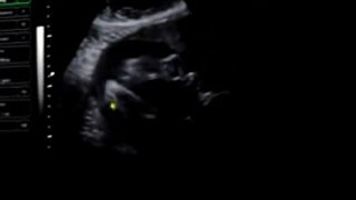 Ultrasound: 25 weeks 3 days pregnant