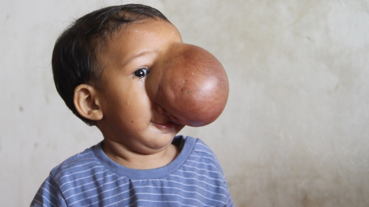 Social Media Secures Life Changing Surgery For Brain Tumour Toddler