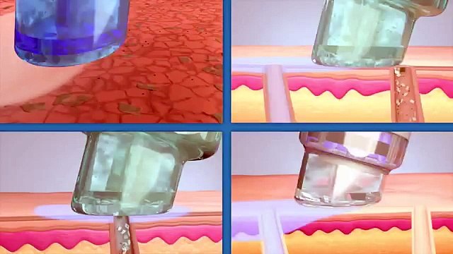 HydraFacial at Bopp Dermatology & Facial Plastic Surgery