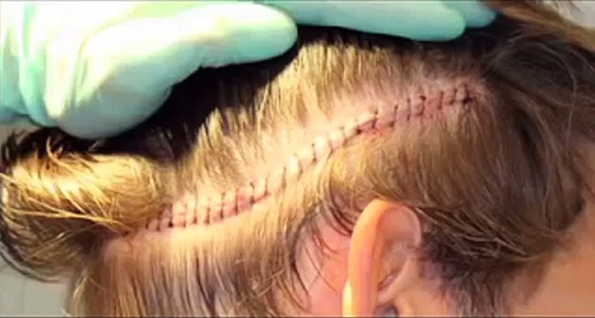 NeoGraft at Bopp Dermatology & Facial Plastic Surgery