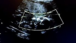 ultrasound 3D 4D 23 weeks surrogate IVF pregnancy