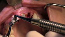 Atraumatic Extractions and Site Preservation Bone Grafting - Kazemi Oral Surgery