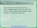 Stroke Treatment Causes, Symptoms and Prevention