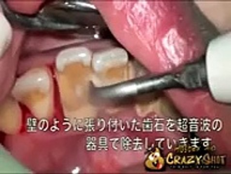 Quand vous restez un moment sans vous brosser les dents voici les résultats