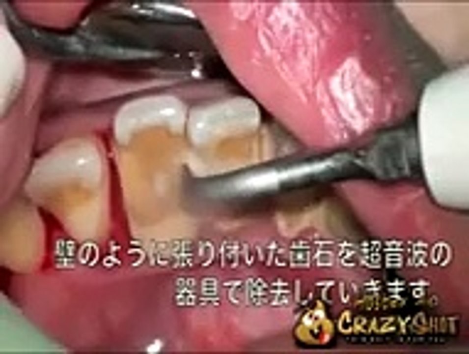Quand vous restez un moment sans vous brosser les dents voici les résultats