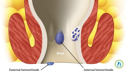 Understanding Hemorrhoids: An Overview