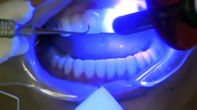 yenimahalle dis klinigi - porselen dis tedavisi - vegadent.net