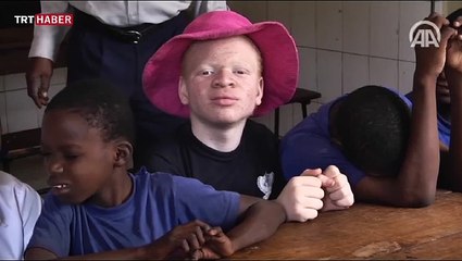 Afrika'nın talihsiz 'albinoları'