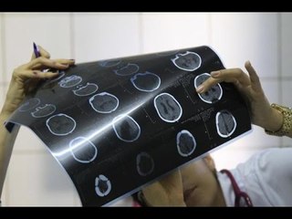 Microcefalia: Entenda a Doença e Sua Relação com o Zika vírus 🧠