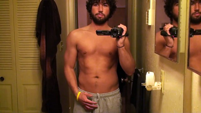 Pectus Excavatum -Clinton- Day Before bar removal Video #15