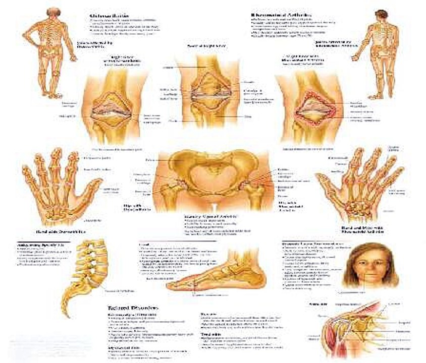 Rheumatoid Arthritis Symptoms