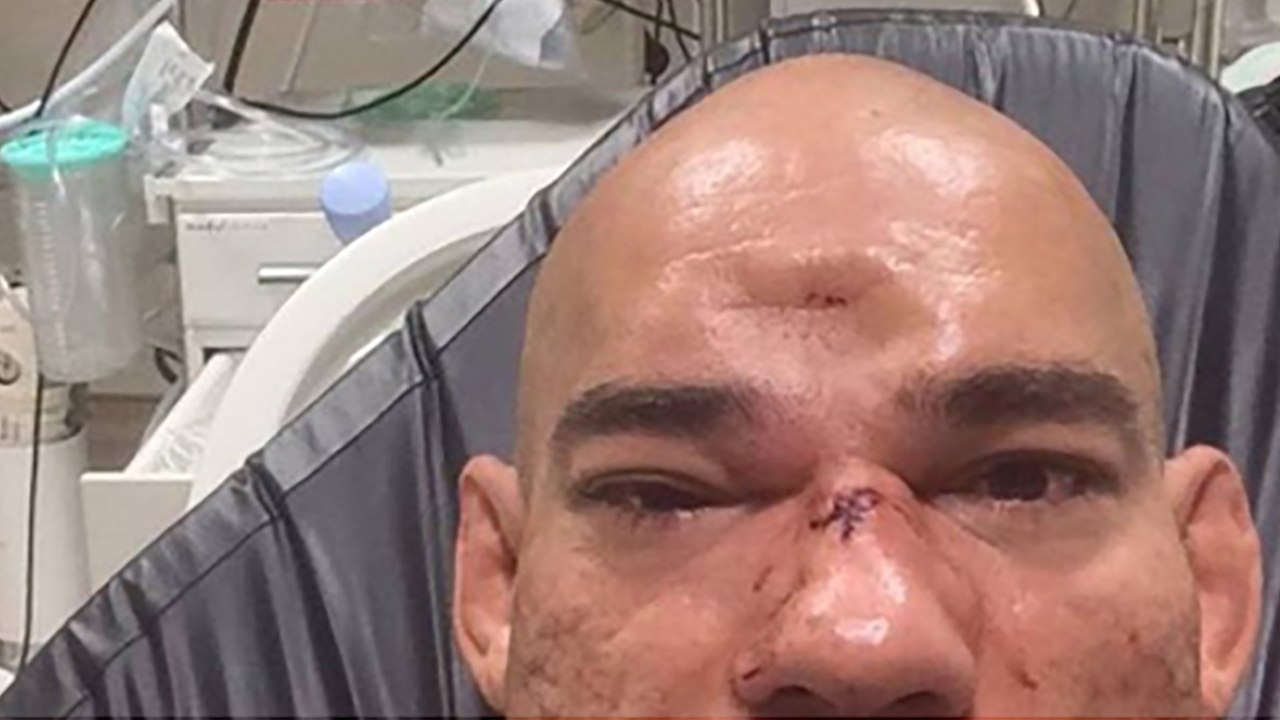 Evangelista 'Cyborg' Santos Has Gruesome Dent In His Head After Bellator Fight