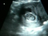 échographie du 3ème mois