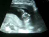 échographie du 3ème mois (2)
