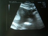 échographie du 3ème mois (3)