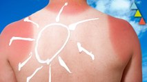 ¿Qué le pasa a tu cuerpo cuando te quemas con el sol