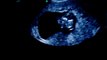 Ultrasound 10 weeks 3 days surrogacy