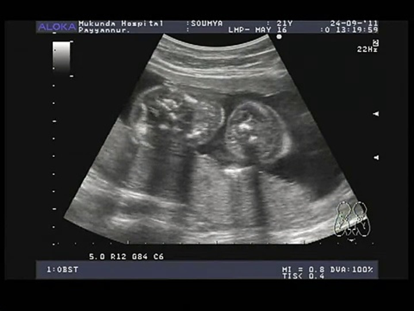 Conjoined Twins Ultrasound 20 Weeks Video Dailymotion