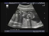 conjoined twins ultrasound 20 weeks