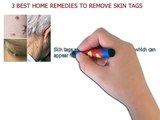 3 Skin Tags Removal Treatments That Cure Skin Tags Fast