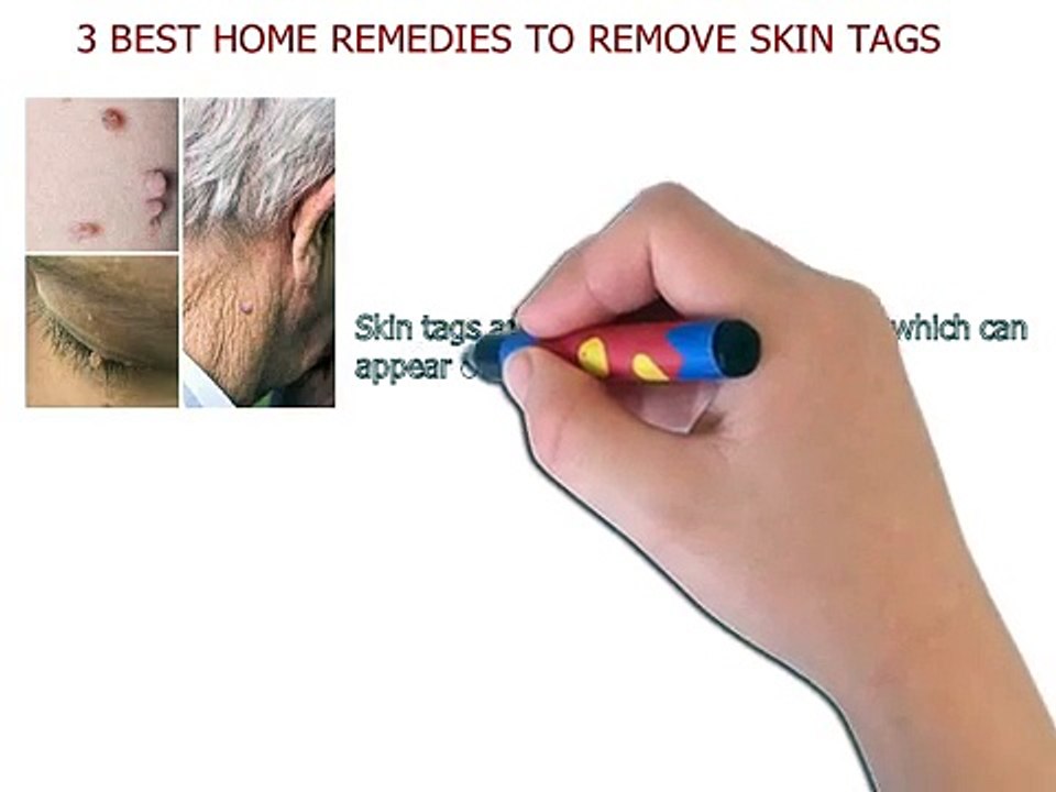 3 Skin Tags Removal Treatments That Cure Skin Tags Fast