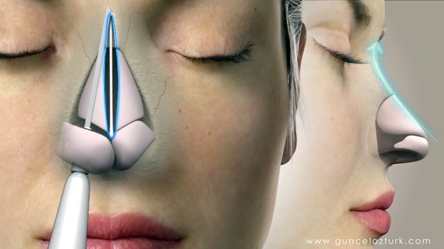 Op. Dr. Güncel Öztürk'ün Kapalı Burun Estetiği Tekniği - Burun Ameliyatı Nasıl Yapılır ?